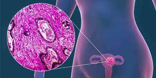 tratamientos Ginecología Oncológica en Merida