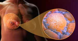 tratamientos Ginecología Oncológica en Merida