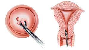 tratamientos Ginecología Oncológica