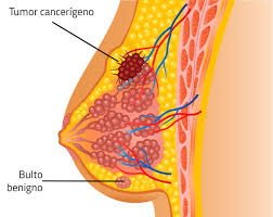 tratamientos Ginecología Oncológica en merida